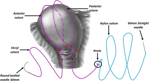 Illustrates the final step of the procedure and how the straight needle and the Nylon suture are out of the uterus and that only the Vicryl suture embraces the uterus (this figure is our own).