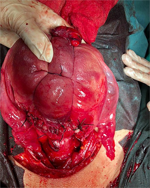 B-lynch suture after it has been applied.