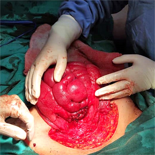 B-lynch suture after it has been applied.