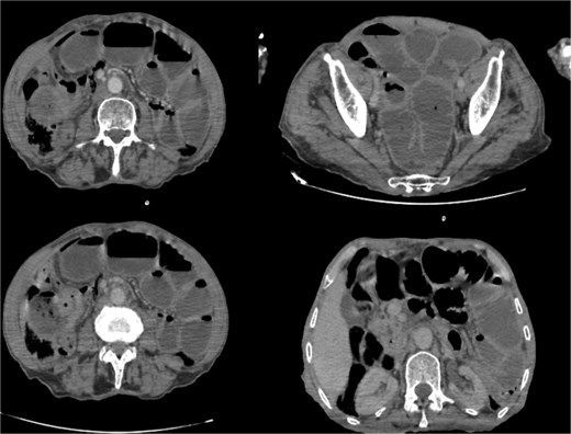 Abdominal computed tomography scan showing dilated jejunal loops; (*): Ileal mass.