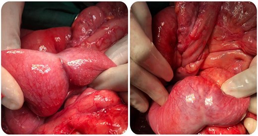 Intraoperative images of the mass.