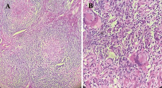 Histological images showing granulomatous inflammatory changes with epithelioid giant cells, as well as early caseous necrosis.