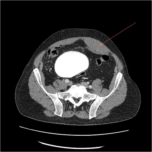 CT scan showing left RSH (arrow).