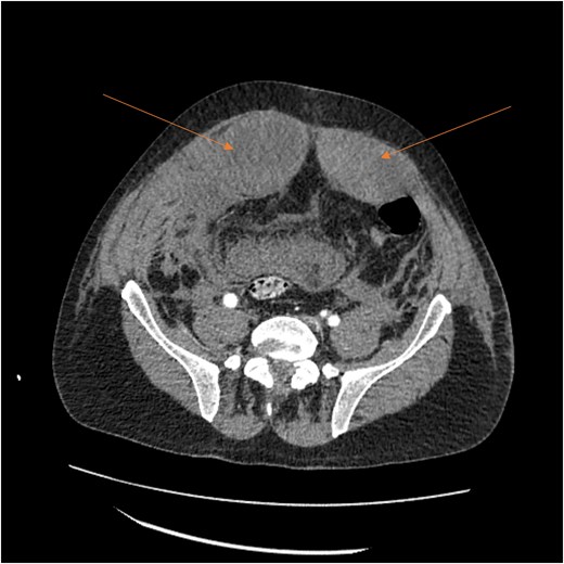 A follow-up CT scan showing progression of the RSH (arrows).