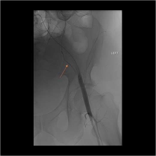 Angiogram of the left inferior epigastric artery (arrow) demonstrating no active bleeding.