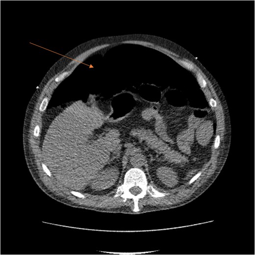 CT scan demonstrating pneumo-peritoneum (arrow), indicative of a hollow viscus perforation.
