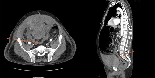 CT scan demonstrating compression of large bowel (arrows) by the enlarged hematoma.