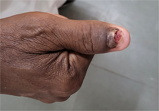 Recurrent lesion over left thumb.