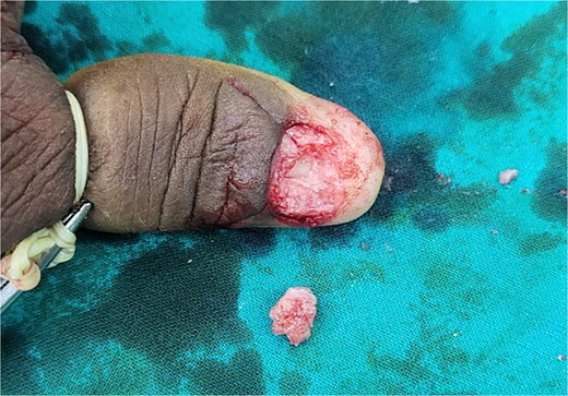 Intra-operative image after excision of lesion.