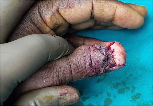 Reconstruction with V-Y advancement flap.