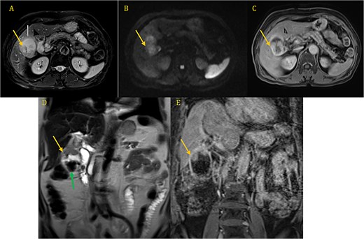 CP-MRI demonstrates markedly dilated gallbladder with cholelithiasis (green arrow) and wall thickening involving the superior portion and the infindubulum (yellow arrow) in iso-signal on T2 (A, D), restrictive on DWI (B), with a late enhacement after injection (C, E).