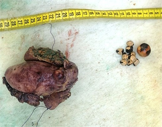 Macroscopic image of cholecystectomy including liver segment.