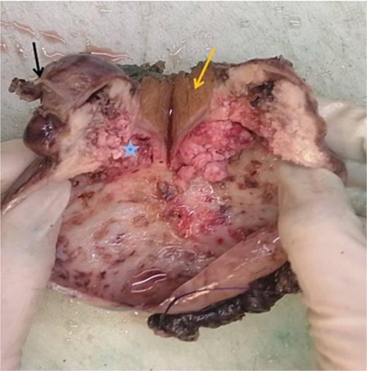 Macroscopic image of cut section showing the liver segment (yellow arrow), neck of the gallbladder (black arrow) and mass (blue star).