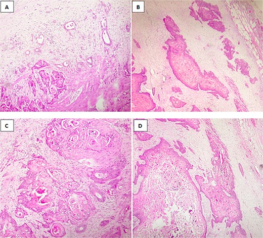 Histological image of adenosquamous carcinoma of the gallbladder showing both glandular and squamous components, with evident areas of keratinization. (A, B) H&E stain, ×100; (C, D) H&E stain, ×200.