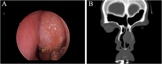 (A) Nasal endoscopic examination showing left nasal septal mass. (B) Computed tomography scan of the paranasal sinuses showing a focal soft tissue lesion arising from the left deviated nasal septum, causing thinning of the left nasal bone measuring 2.2 × 1.7 × 2.7 cm.