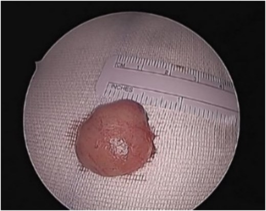 Nasal septal mass post endoscopic excision.