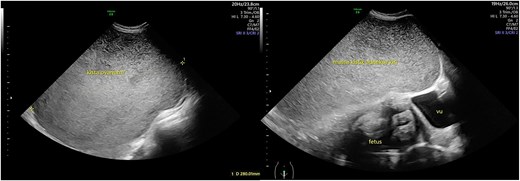 Ultrasound view of the cystic mass. The mass was unilocular without a solid part with a diameter of 28 cm.