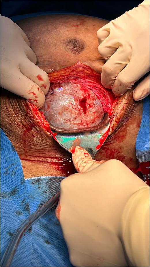 Abdominal view after the peritoneum was opened. Show large cystic mass filled the abdominal cavity obstructing the access to the uterus.