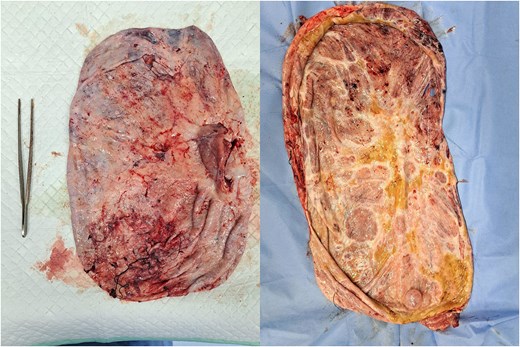 The outer and inside parts of the ovarian tumor were unilocular, with no solid part found.