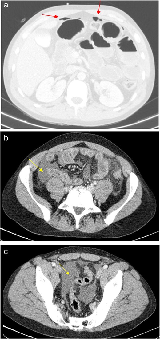 (a) Pneumoperitoneum (arrowheads). (b) Free fluid in the right iliac fossa (arrowhead). (c) Free fluid in the pelvis (arrowhead).