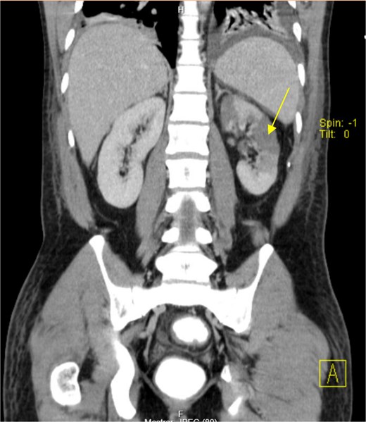 Left kidney infarction (arrow).