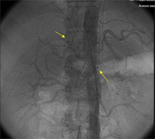 Angiography of the abdominal aorta revealed arterial microaneurysms suggesting polyarteritis nodosa (arrows).