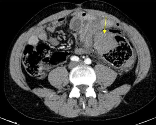 Circular densification of the sigmoid colon wall, distal to the previous anastomosis (arrow).