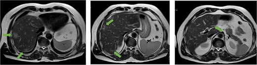 Axial MRI slices obtained preoperatively showing bilobar colorectal liver metastases. Key lesions are marked with arrows.