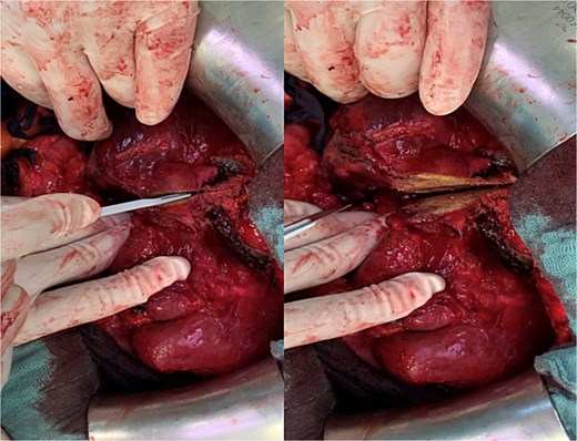 Parenchymal transection of the liver following prior MWA demarcation.