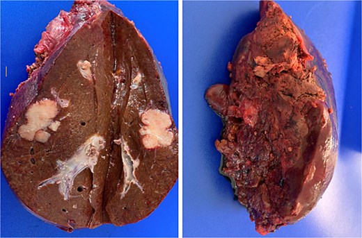 Post-resection specimen of the right hepatic lobe (segments V–VIII) showing multiple metastases from colorectal carcinoma.
