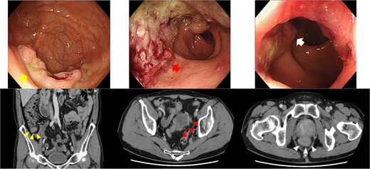 Endoscopy and enhanced CT endoscopy showed tumors in the cecum (LST-G, upper left), sigmoid (type 2, upper middle), and rectum (type 2, upper right). Enhanced CT provided important insights into the wall thickness in the cecum (lower left), sigmoid colon (lower middle), and rectum (lower right).
