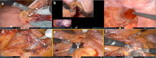 Field of view of the console. (a) Medial approach for sigmoid colon and clipped and ligated IMA. (b) Rectum was mobilized passively upon rendezvous with the transperineal approach. (c) Total mesorectal excision was performed in cooperation with the perineal approach while preserving the pelvic splanchnic nerves, (d) Medial approach for ileocecal resection and ligated ileocecal artery and vein. (e) Lateral approach for ileocecal resection using relocate mode. (f) Intracorporeal anastomosis.