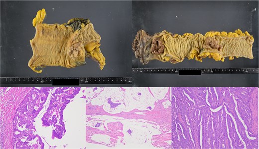 Resected specimen and Hematoxylin and eosin (H&E) staining. (a) Resected specimen from the cecum. (b) Resected specimens from sigmoid colon and rectum. (c) H&E staining of cecum (×100) b: Sigmoid (×100) c: Rectum (×100).