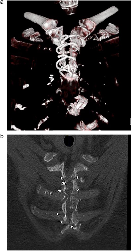 (a) Pre-operative CT scan showing dehisced upper hemi-sternum. (b) Pre-operative CT showing significant bony loss on the right hemi-sternum.