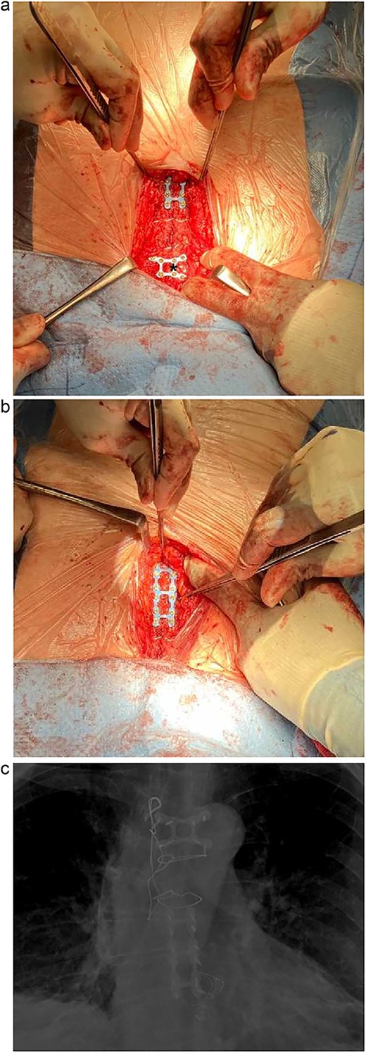 (a) Intra-operative photo demonstrating titanium X-plate (Biomet-8 hole) marked by *. (b) Intra-operative photo demonstrating titanium ladder plate (Biomet-12 hole). (c) Post-operative CXR demonstrating the plated sternum.