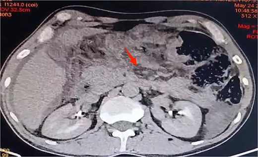 Axial view of contrast-enhanced abdominal CT scan revealing Balthazar E pancreatitis with peripancreatic necrosis.