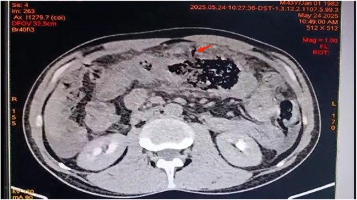 Axial view of contrast-enhanced abdominal CT scan revealing transverse colon wall thickening and a sealed transverse colon perforation.