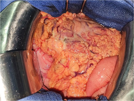 Intraoperative image showing the thickened and infiltrated appearance of the transverse colon with a perforation contained by the omentum and the first ileal loop.
