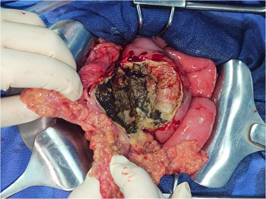Intraoperative image showing the perforation of the middle third of the transverse colon.