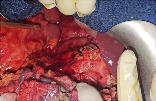 Intraoperative image of the lesser sac (or omental bursa) showing pancreatic infiltration with necrosis collections (or necrotic fluid collections).