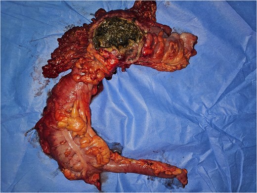 Image of the surgical specimen of a right hemicolectomy showing the perforation.