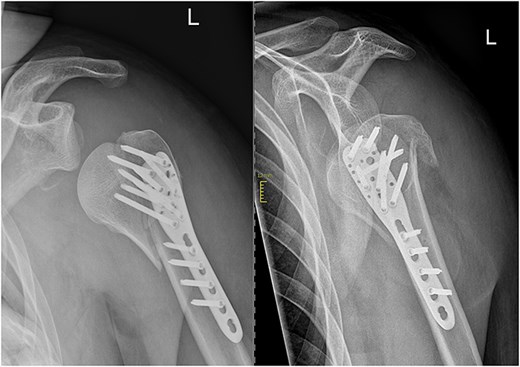 Two days after surgery.