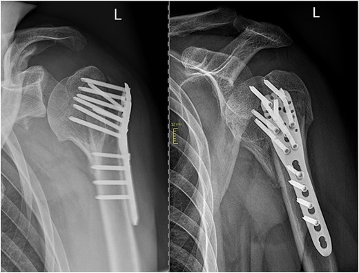 Six months after surgery.