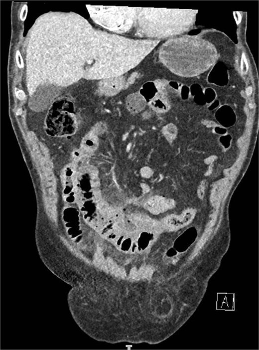 CTA showing a long segment of small bowel with inflammatory wall thickening and fat stranding of the mesentery with multiple air bubbles.
