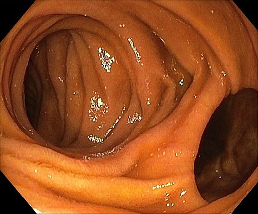 Endoscopy showing a jejunal diverticulum on the right side.