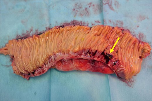 Cut open small bowel segment verifying the diverticular perforation (arrow) from an intraluminal perspective.