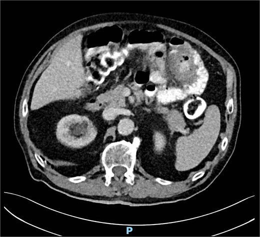CT scan showing a mesenteric mass in the upper left quadrant.