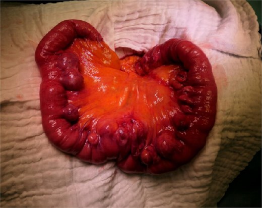 Intraoperative finding of JD with a chronic inflammation matching the findings in the CT scan.