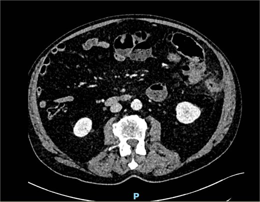 CT scan showing signs of inflammation and free air in the left abdomen.