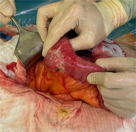 Intraoperative finding of a perforated jejunal diverticulum.